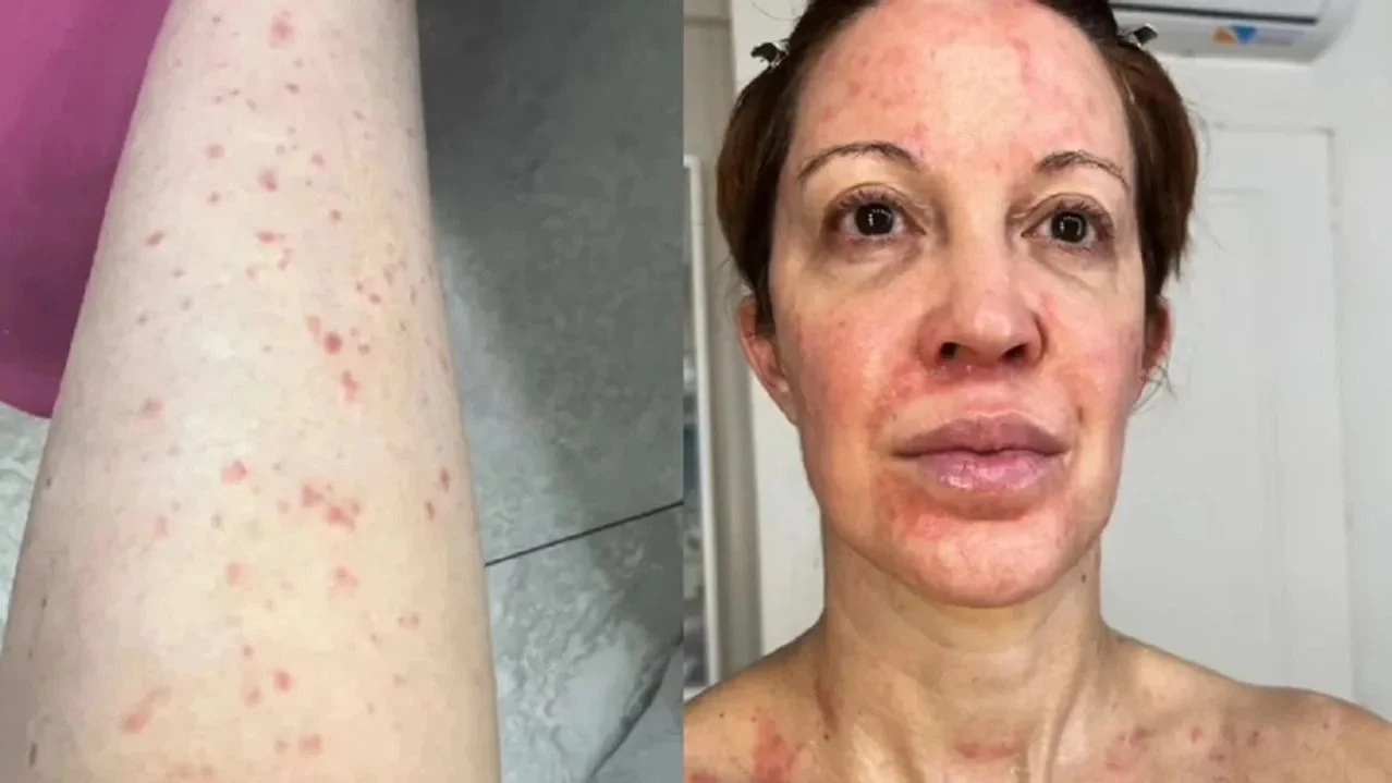 Miriam Lanzoni reveló que padeció psoriasis y compartió imágenes de su batalla contra la enfermedad