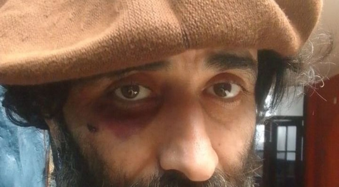 Brutal asalto en La Perla: se enfrentó al delincuente, terminó con puntos en la cara y casi pierde un ojo