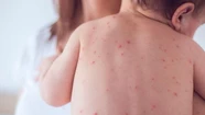 Alerta por sarampión: detectan 44 casos en el país