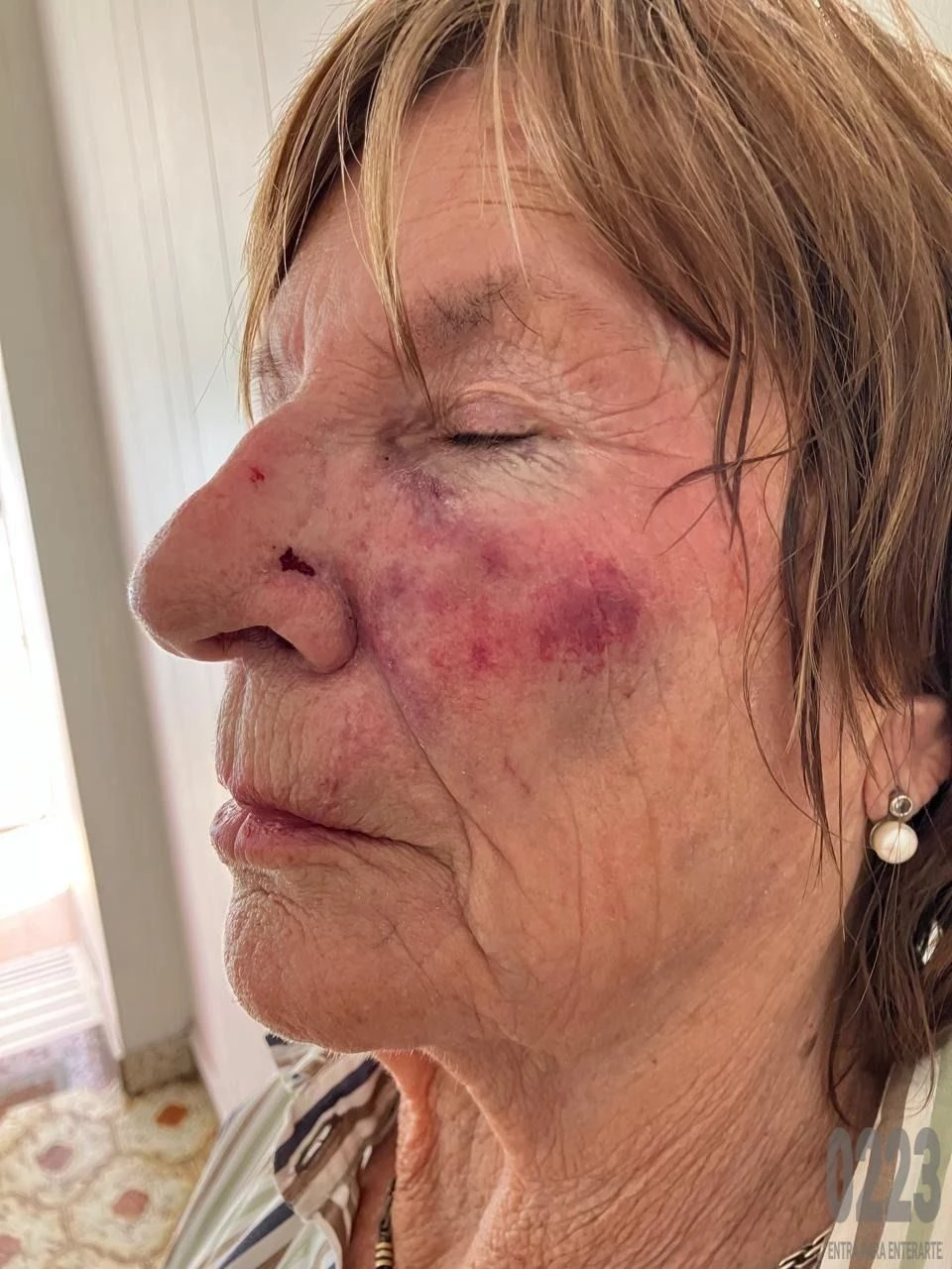 Así quedó el rostro de la jubilada, quien padece de parkinson y el martes cumple 82 años.