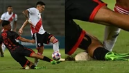 La fractura mantendrá a Kraneviter entre seis y ocho meses afuera de las canchas. 